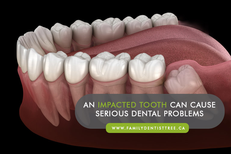 An impacted tooth can cause serious dental problems